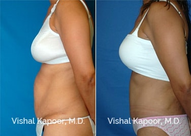 Patient 07 Side View Tummy Tuck Beverly Hills Cosmetic Plastic Surgery Doc