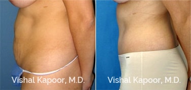 Patient 13 Side View Tummy Tuck Beverly Hills Cosmetic Plastic Surgery Doc