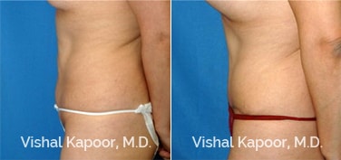 Patient 17 Side View Tummy Tuck Beverly Hills Cosmetic Plastic Surgery Doc