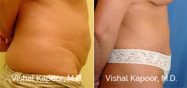 Patient 18 Side View Tummy Tuck Beverly Hills Cosmetic Plastic Surgery Doc