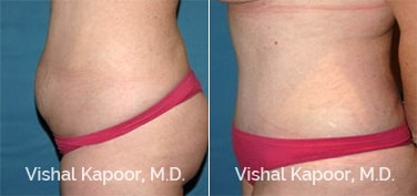 Patient 20 Side View Tummy Tuck Beverly Hills Cosmetic Plastic Surgery Doc
