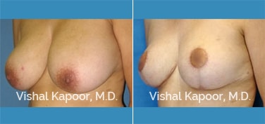 Patient 01 3/4 View Breast Reduction Beverly Hills Cosmetic Plastic Surgery Doc