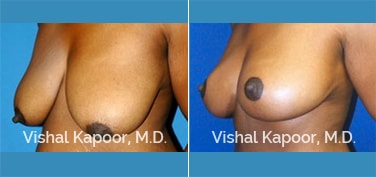 Patient 02 3/4 View Breast Reduction Beverly Hills Cosmetic Plastic Surgery Doc