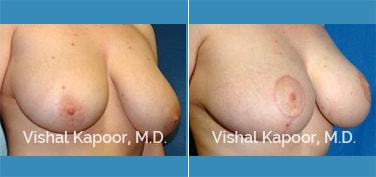 Patient 03 3/4 View Breast Lift Beverly Hills Cosmetic Plastic Surgery Doc