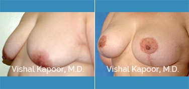 Patient 05 3/4 View Breast Lift Beverly Hills Cosmetic Plastic Surgery Doc