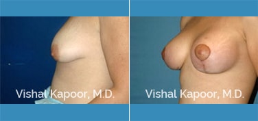 Patient 09 Side View Breast Lift Beverly Hills Cosmetic Plastic Surgery Doc