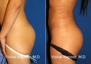 Patient 01 Left Side View Brazilian Butt Lift Beverly Hills Cosmetic Plastic Surgery Doc