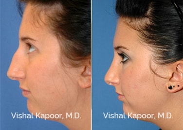Patient 05 Side View Revision Rhinoplasty Beverly Hills Cosmetic Plastic Surgery Doc