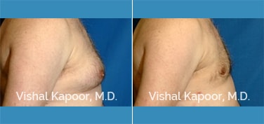 Patient 07 Side View Male Breast Reduction Beverly Hills Cosmetic Plastic Surgery Doc