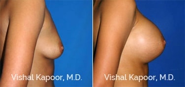 Patient 19 Side View Breast Augmentation Beverly Hills Cosmetic Plastic Surgery Doc