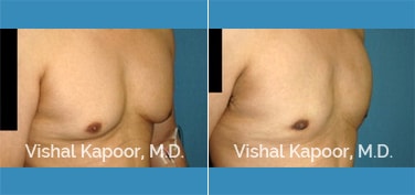 Patient 28 Right Side 3/4 View Male Breast Reduction Beverly Hills Cosmetic Plastic Surgery Doc