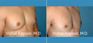 Patient 29 Right Side 3/4 View Male Breast Reduction Beverly Hills Cosmetic Plastic Surgery Doc