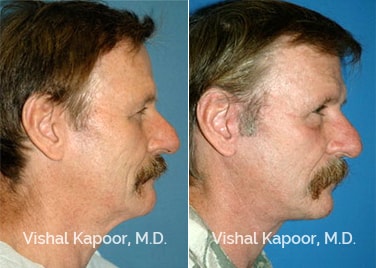 Patient 01 Side View Face Neck Rejuvenation Beverly Hills Cosmetic Plastic Surgery Doc