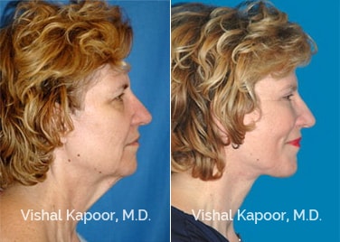 Patient 03 Side View Face Neck Rejuvenation Beverly Hills Cosmetic Plastic Surgery Doc