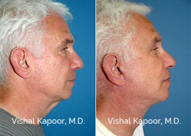 Patient 03 Side View Face Neck Rejuvenation Beverly Hills Cosmetic Plastic Surgery Doc