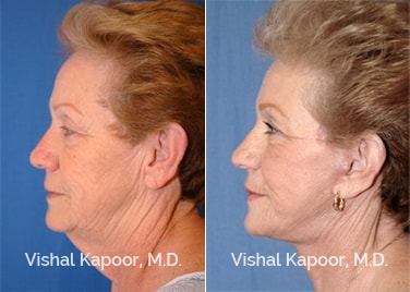 Patient 04 Side View Face Neck Rejuvenation Beverly Hills Cosmetic Plastic Surgery Doc