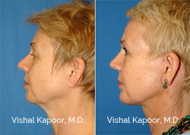Patient 08 Side View Face Neck Rejuvenation Beverly Hills Cosmetic Plastic Surgery Doc
