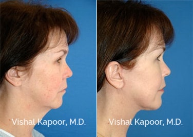 Patient 06 Side View Eyelid Surgery Rejuvenation Beverly Hills Cosmetic Plastic Surgery Doc