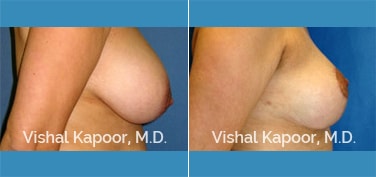 Patient 10 Side View Breast Lift Beverly Hills Cosmetic Plastic Surgery Doc