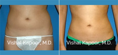 Patient 17 Side View Liposuction Beverly Hills Cosmetic Plastic Surgery Doc