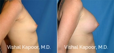 Patient 26 Side View Breast Augmentation Beverly Hills Cosmetic Plastic Surgery Doc