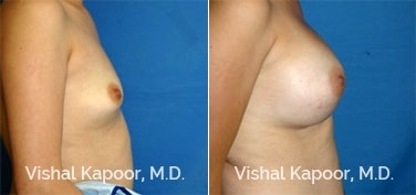 Patient 27 3/4 View Breast Augmentation Beverly Hills Cosmetic Plastic Surgery Doc