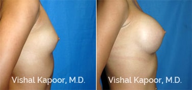Patient 35 Side View Breast Augmentation Beverly Hills Cosmetic Plastic Surgery Doc
