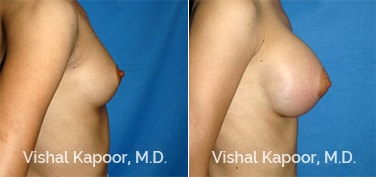 Patient 36 Side View Breast Augmentation Beverly Hills Cosmetic Plastic Surgery Doc