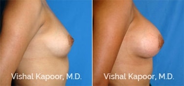 Patient 37 Side View Breast Augmentation Beverly Hills Cosmetic Plastic Surgery Doc