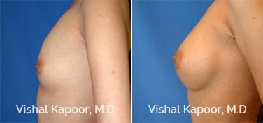 Patient 38 Side View Breast Augmentation Beverly Hills Cosmetic Plastic Surgery Doc