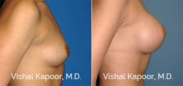 Patient 43 Side View Breast Augmentation Beverly Hills Cosmetic Plastic Surgery Doc