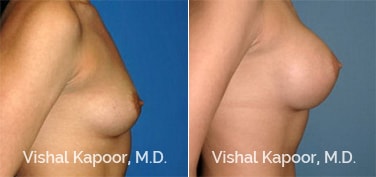 Patient 44 Side View Breast Augmentation Beverly Hills Cosmetic Plastic Surgery Doc