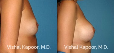 Patient 46 Side View Breast Augmentation Beverly Hills Cosmetic Plastic Surgery Doc