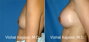 Patient 50 Side View Breast Augmentation Beverly Hills Cosmetic Plastic Surgery Doc