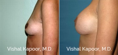Patient 53 Side View Breast Augmentation Beverly Hills Cosmetic Plastic Surgery Doc
