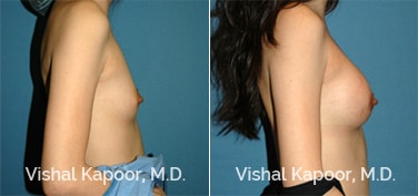 Patient 61 Side View Breast Augmentation Beverly Hills Cosmetic Plastic Surgery Doc