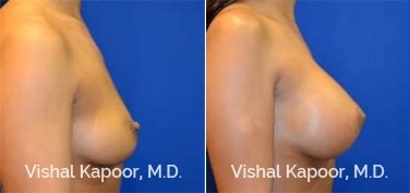 Patient 78 Right Side View Breast Augmentation Beverly Hills Cosmetic Plastic Surgery Doc