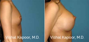 Patient 84 Side View Breast Augmentation Beverly Hills Cosmetic Plastic Surgery Doc