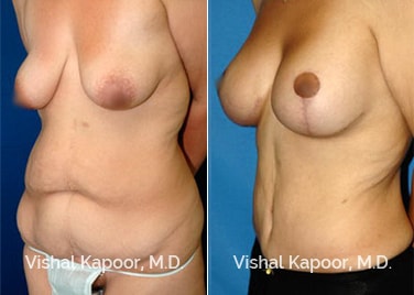 Patient 01 3/4 View Breast Lift Beverly Hills Cosmetic Plastic Surgery Doc