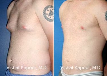 Patient 01 3/4 View Male Breast Reduction Beverly Hills Cosmetic Plastic Surgery Doc