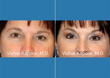 Patient 09 Closeup View Face Neck Rejuvenation Beverly Hills Cosmetic Plastic Surgery Doc