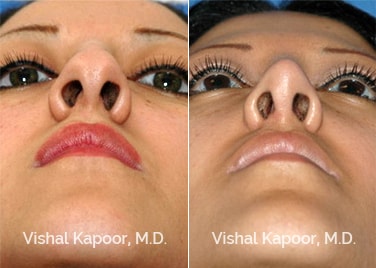 Patient 06 Upper View Revision Rhinoplasty Beverly Hills Cosmetic Plastic Surgery Doc