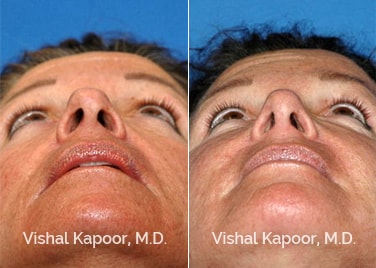 Patient 09 Upper View Revision Rhinoplasty Beverly Hills Cosmetic Plastic Surgery Doc