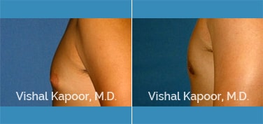 Patient 27 Side View Male Breast Reduction Beverly Hills Cosmetic Plastic Surgery Doc