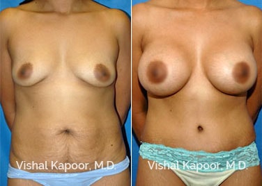 Patient 04 Front View Breast Augmentation Beverly Hills Cosmetic Plastic Surgery Doc