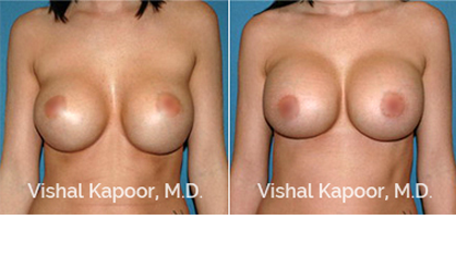 Breast Revision Beverly Hills