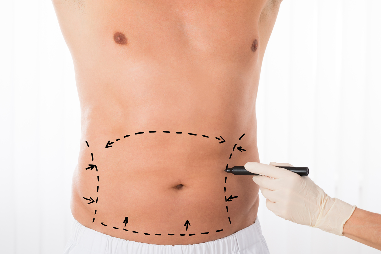 Male Liposuction