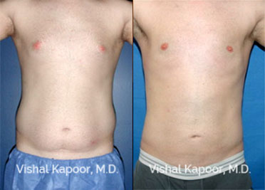 male breast reduction beverly hills