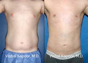 beverly hills breast reduction Beverly hills breast reduction
