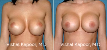 Breast Asymmetry Beverly Hills Before and After Plastic Surgery